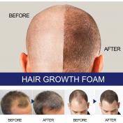 Extra Strength Hair Loss & Hair Growth Scalp Foam For Men